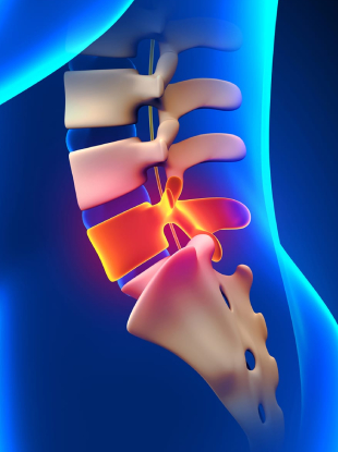 Microscopic Spine Surgery in Ahmedabad, Gujarat, India
